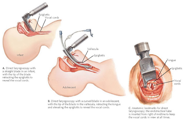 Figure 1-4 Endotracheal intubation.