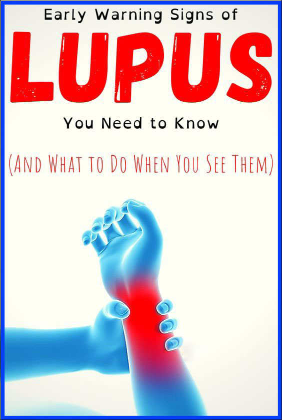 13 Early Warning Signs Of Lupus You Need To Know And What To Do The