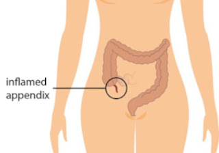 Signs and Symptoms of Appendicitis