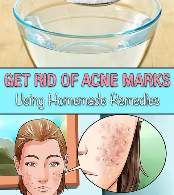 Get Rid of Acne Marks Using Homemade Remedies wellness days