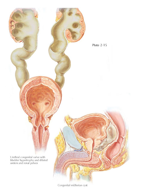CONGENITAL VALVE FORMATION AND CYST