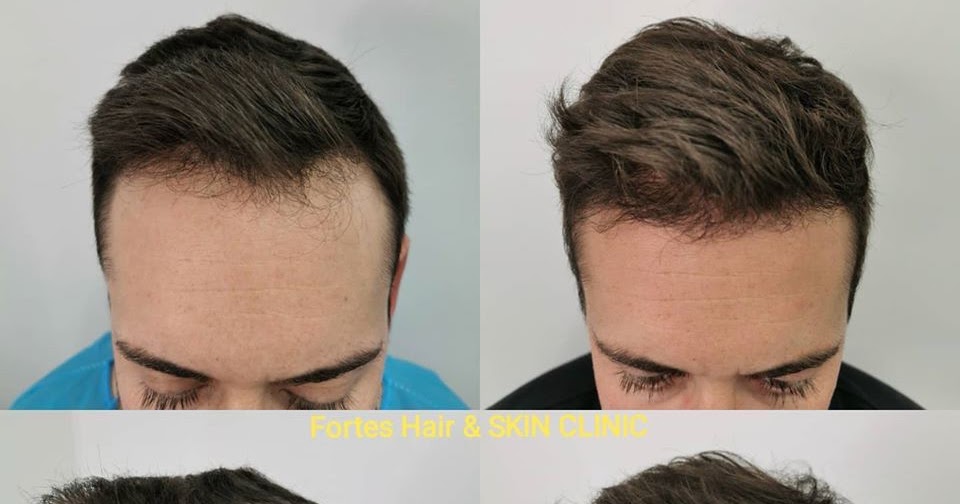Hair Loss How Is It Affecting Your Confidence Level?