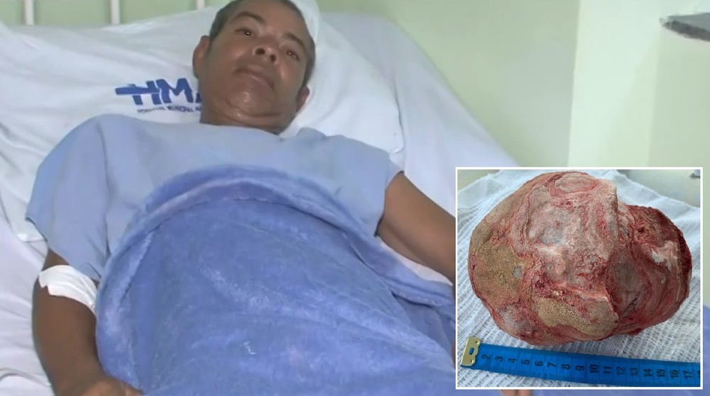 Recuperação De Cirurgia De Pedra Na Bexiga Lavrador que teve pedra de 1,3 Kg e 18 cm retirada da bexiga na Bahia