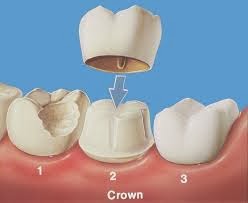 http://www.dentistinchennai.com/dental-crowns.php