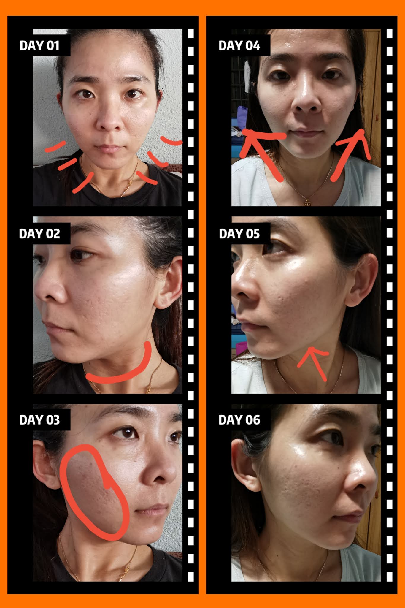 My IDSTransformMe Journey PicoLaser Treatment after IDS Skincare [Sponsored] MollyMia