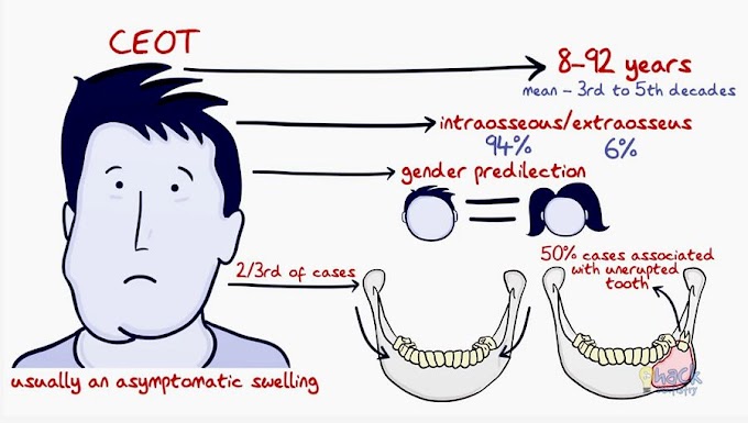 ODONTOGENIC TUMORS: Calcifying Epithelial Odontogenic Tumor - Hack Dentistry