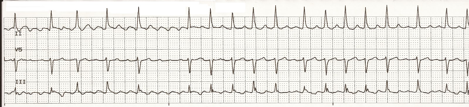 atrial flutter vs svt