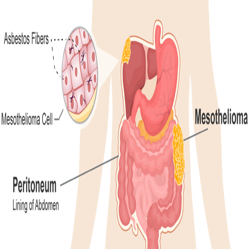 mesothelioma lung cancer symptoms
