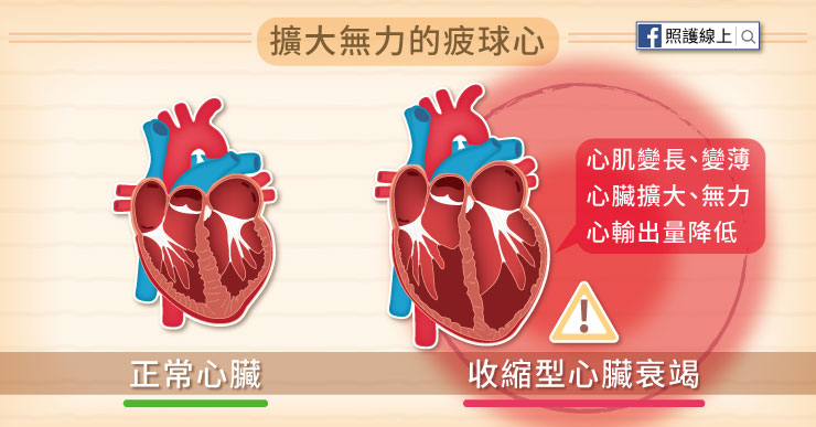 心肌變長、變薄,心臟擴大又無力,所以心臟衰竭又被稱作「疲球心」
