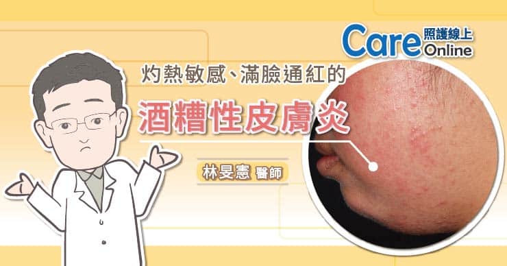 灼熱敏感、滿臉通紅的酒糟性皮膚炎