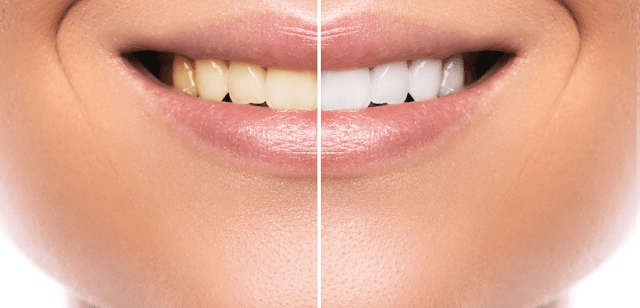 professional teeth whitening vs at home By Barbies Beauty Bits professional teeth whitening vs at home By Barbies Beauty Bits