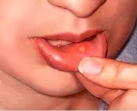 Canker Sores: Causes, Symptoms and Treatments