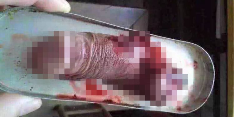 Woman Charged After Cheating Husband's Penis Is Chopped Off With Knife