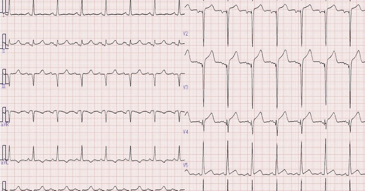 PCIと64列MDCTの日々 Our daily Coronary intervention and 64-row MDCT