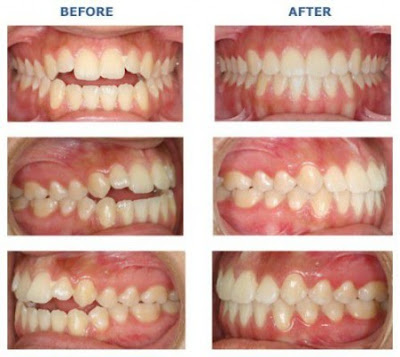 Phương pháp niềng răng mọc lệch lạc hiệu quả tốt