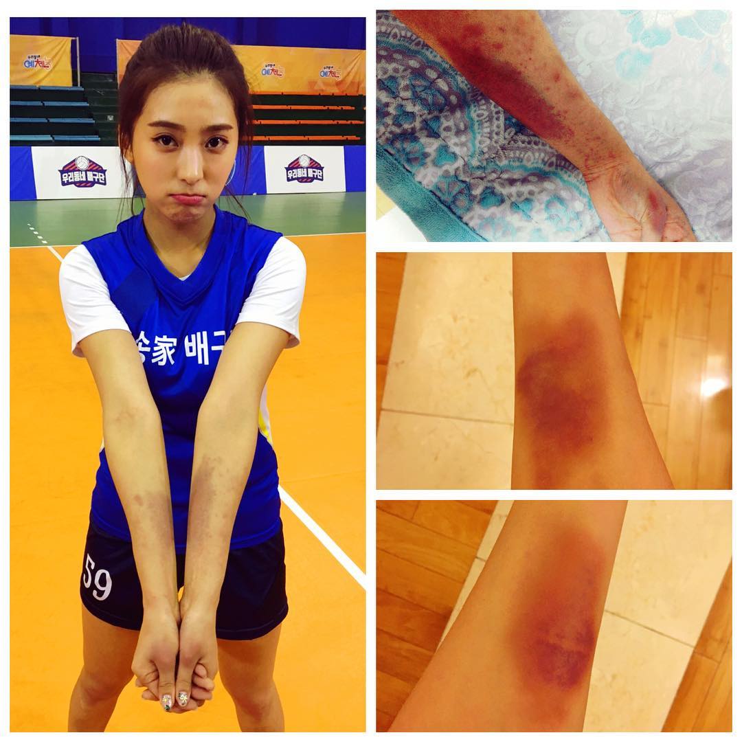 SISTAR Bora Acquires Severe Bruises From Volleyball Daily K Pop News