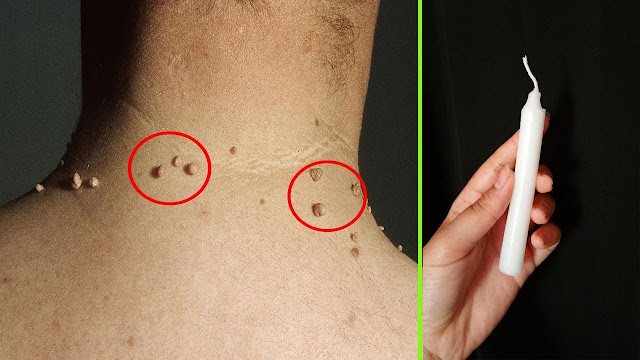 بشمعة واحدة فقط تخلصي من الثآليل ستتختفي وتموت للأبد علاج الزوائد الجلدية