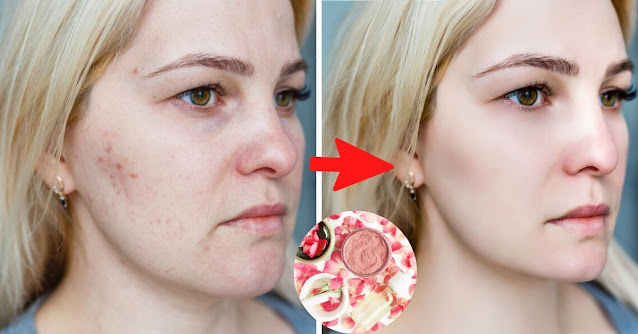 Eau de rose maison Réduire l'acné et autres cicatrices
