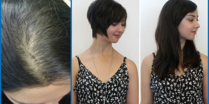Best Hair Transplantation Dubai Regrow Hairs With Onion Juice