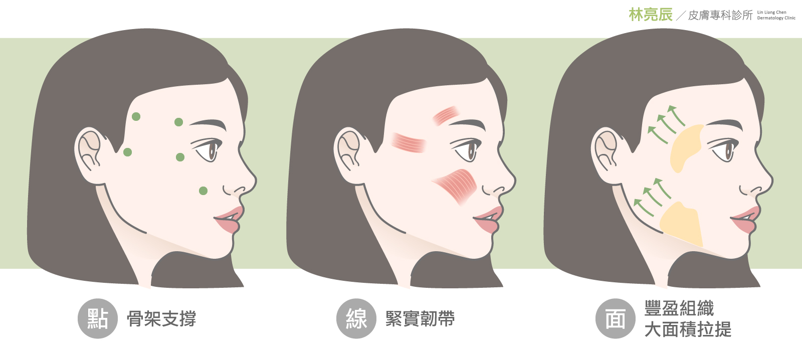 舒顏萃液態拉皮3D聚左旋乳酸童顏針童妍針膠原蛋白增生劑新竹書顏萃林亮辰醫師玻尿酸3