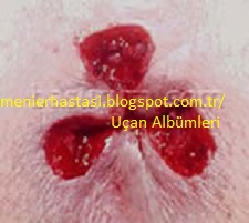 hemoroid basur mayasil cerrahi tedavi