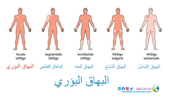 البهاق البؤري، اعراضه و كيفيية علاجه البهاق البؤري، اعراضه و كيفيية علاجه