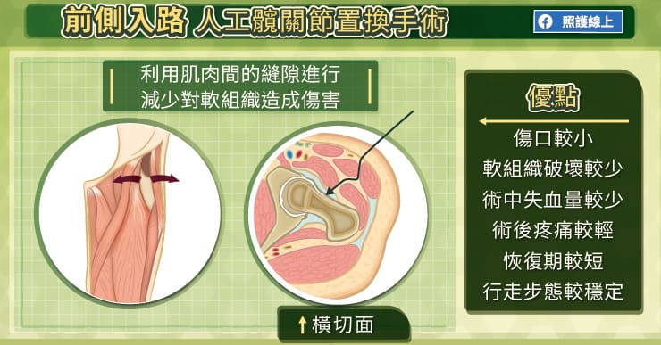 前側入路人工髖關節置換手術