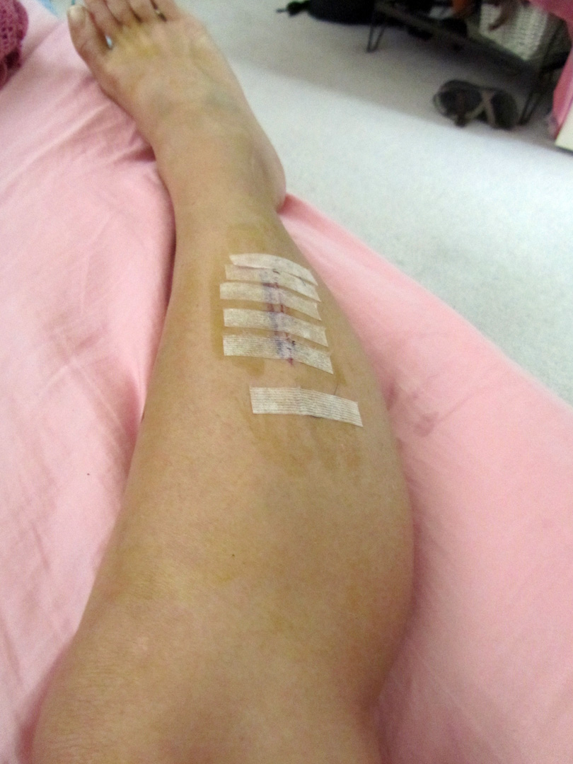 My Experience with Chronic Exertional Compartment Syndrome My Progress