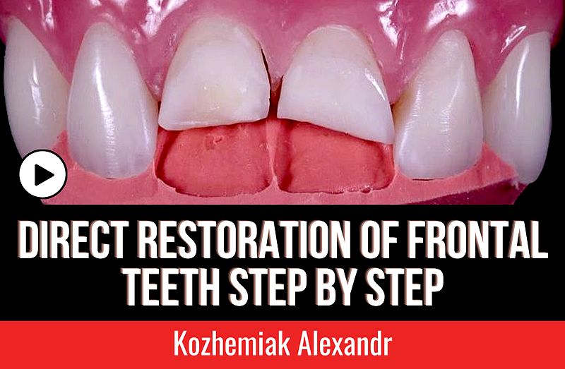 COMPOSITE Direct restoration of frontal teeth Step by Step Kozhemiak