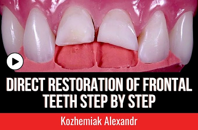 COMPOSITE: Direct restoration of frontal teeth Step by Step - Kozhemiak Alexandr