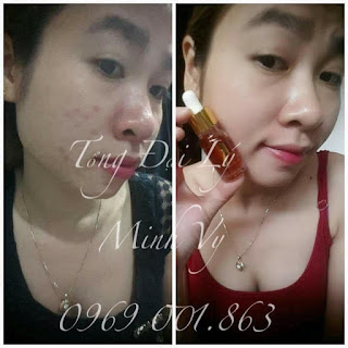serum Kiều beauty queen serum Kiều beauty queen