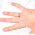 Janeway Lesion Pictures, Definition, Symptoms, Causes, Treatment