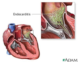 Endocarditis