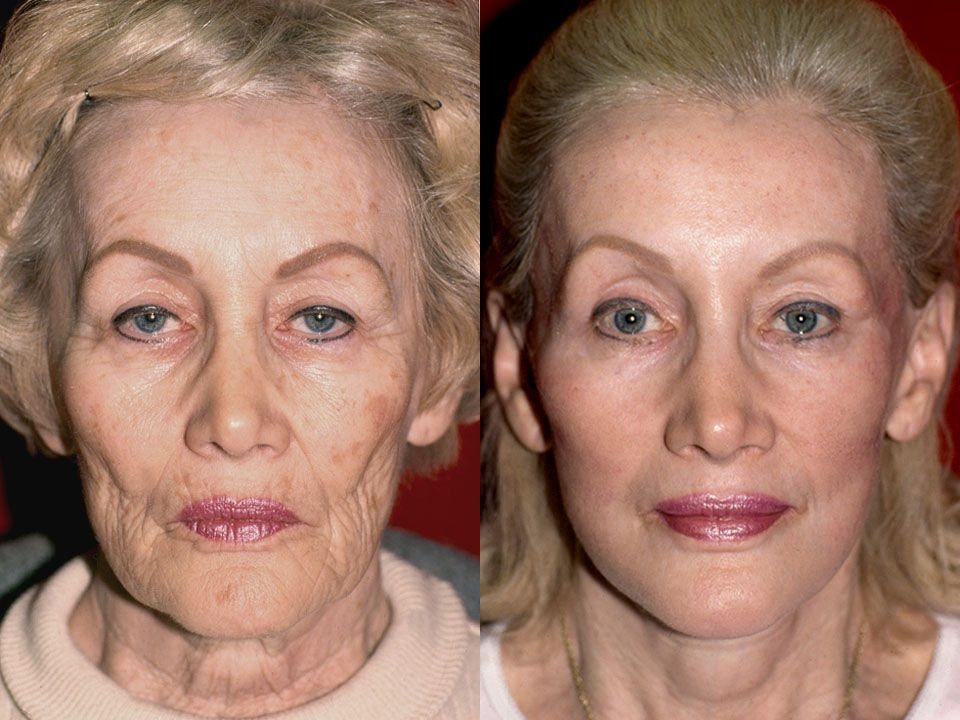 Facial Exercises Produce Wonderful NonSurgical Facelifts Attain An