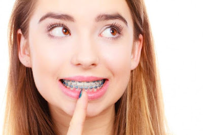 Niềng răng bị tụt lợi nguy hiểm thế nào? 2