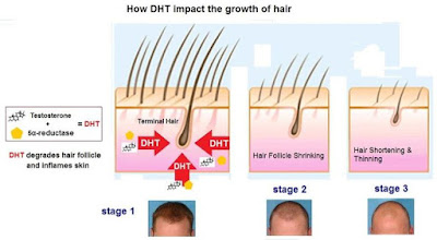 DHT Hormone that causes Hair Loss