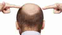 Penyebab Kepala Botak & Rambut Rontok Penyebab Kepala Botak & Rambut Rontok