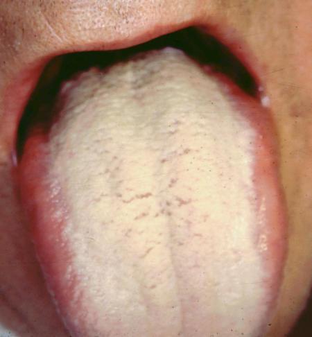 Hairy Coated Tongue 108