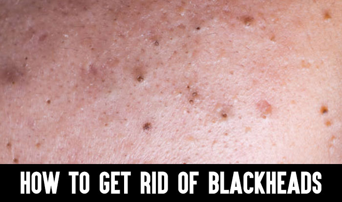 How to Get Rid of Blackheads