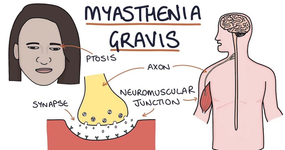 Myasthenia Gravis vs Multiple Sclerosis