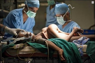 Most Unusual Indian Conjoined Twins Pictures