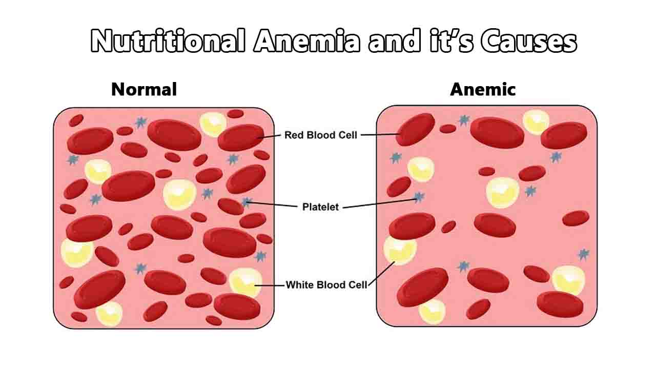 Nutritional Anemia and It's causes