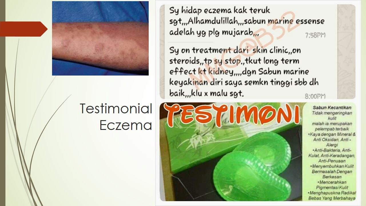 Eczema Teruk Makin Pulih
