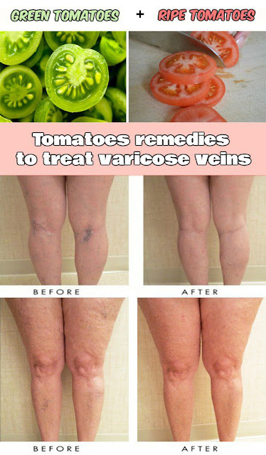 How to Cure Varicose Veins with the Help of Tomato