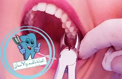 بعد إزالة ضرس العقل جراحيا