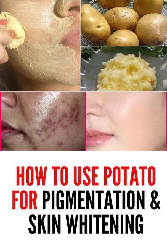 How To Use Potato To Reduce Pigmentation info remedies