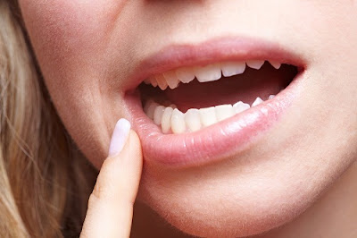 Quy trình nhổ răng khôn tại nha khoa