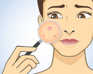Myths About Acne Myths About Acne