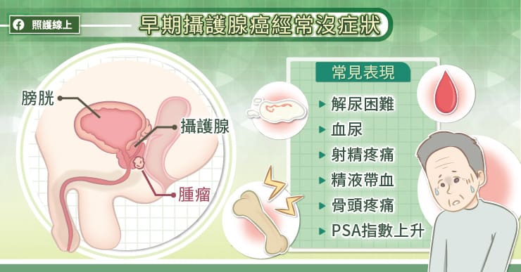 早期攝護腺癌經常沒症狀