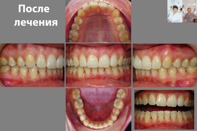 Прикус после ортодонтического лечения Прикус после лечения брекетами